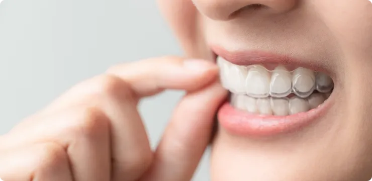 マウスピース矯正イメージ