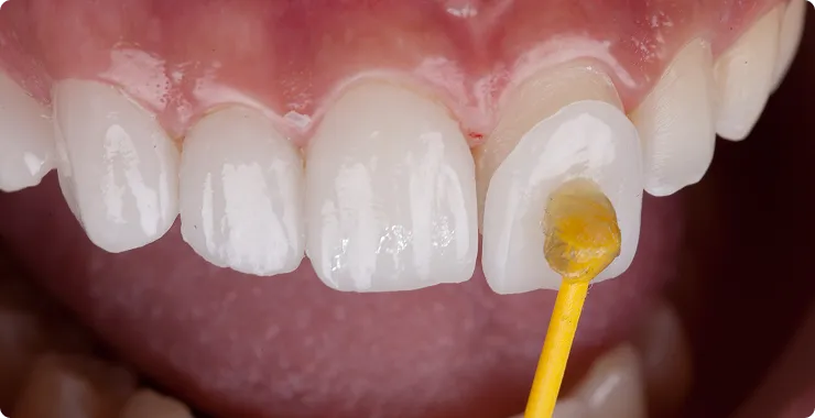 ラミネートベニアイメージ