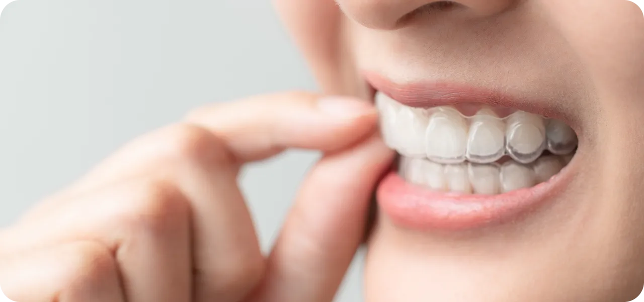 矯正歯科イメージ